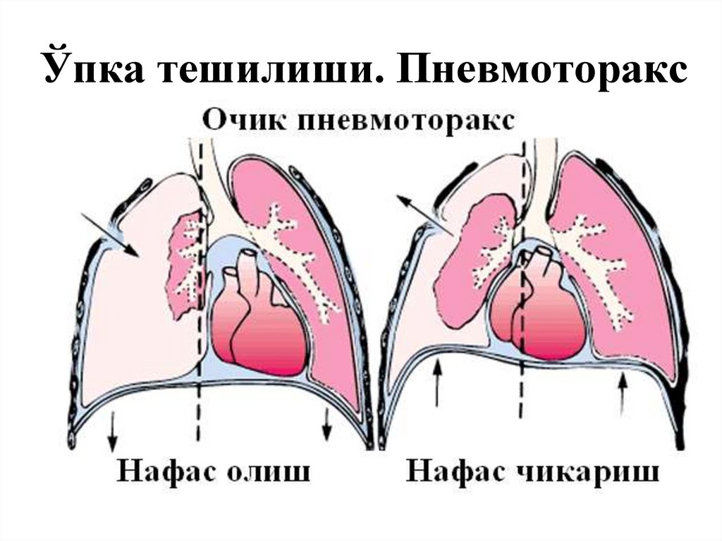 Закрытый пневмоторакс карта вызова