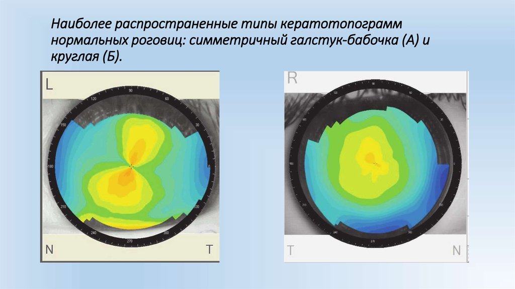 Компьютерная кератотопография что это