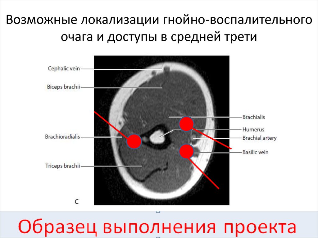 Средняя треть. Очаг воспалительного процесса. Очаг Гнойного воспаления. Локализация в средней трети. Локализация воспалительного очага.