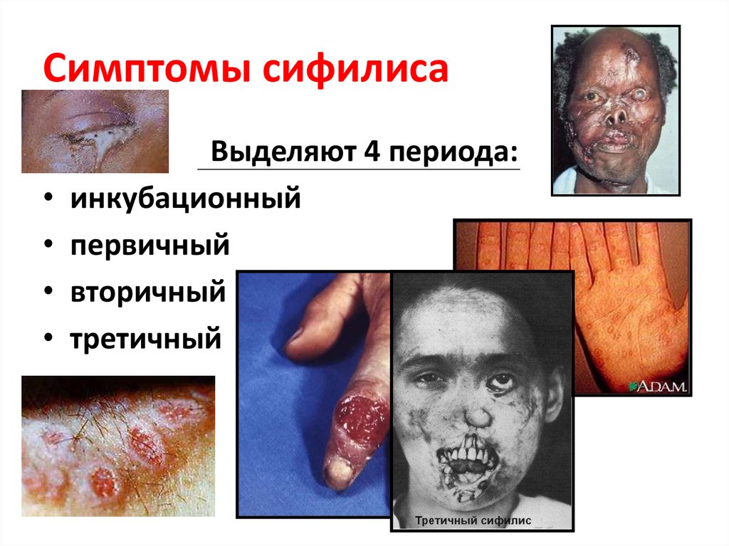 Симптомы сифилиса