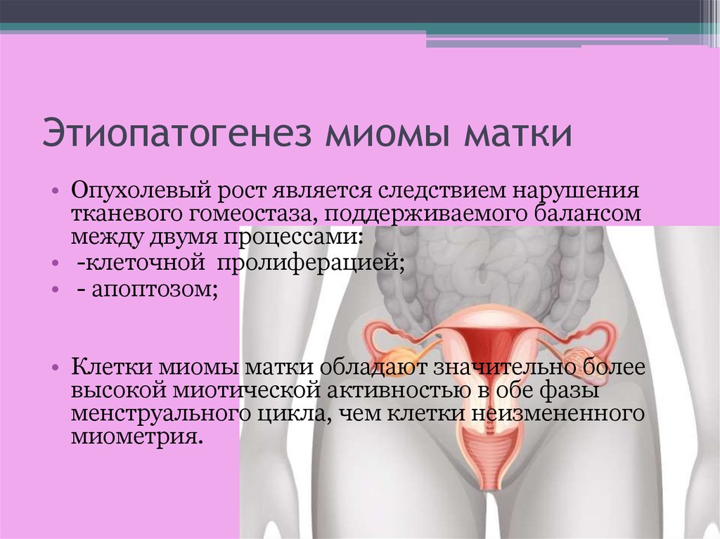 Миома матки стадии. Этиопатогенез миомы матки. Этиопатогенез лейомиомы матки. Вторая фаза миомы матки.