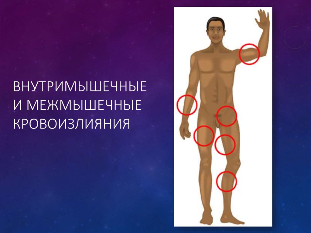 Внутримышечные и межмышечные кровоизлияния