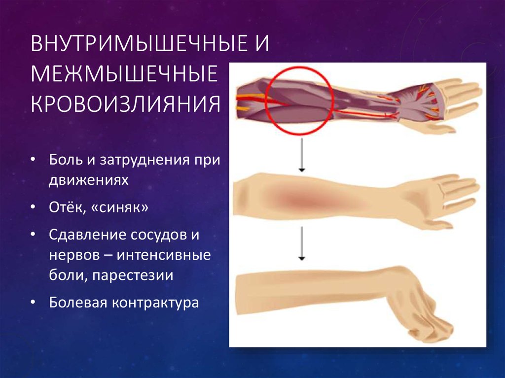Внутримышечные и межмышечные кровоизлияния