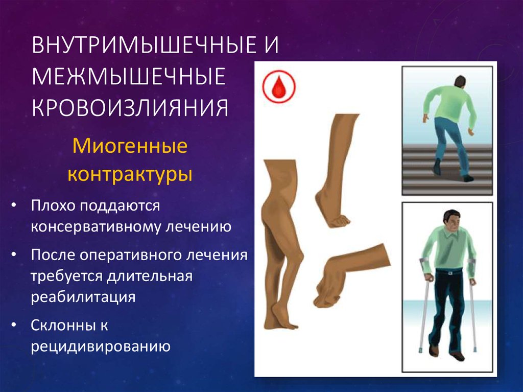 Внутримышечные и межмышечные кровоизлияния