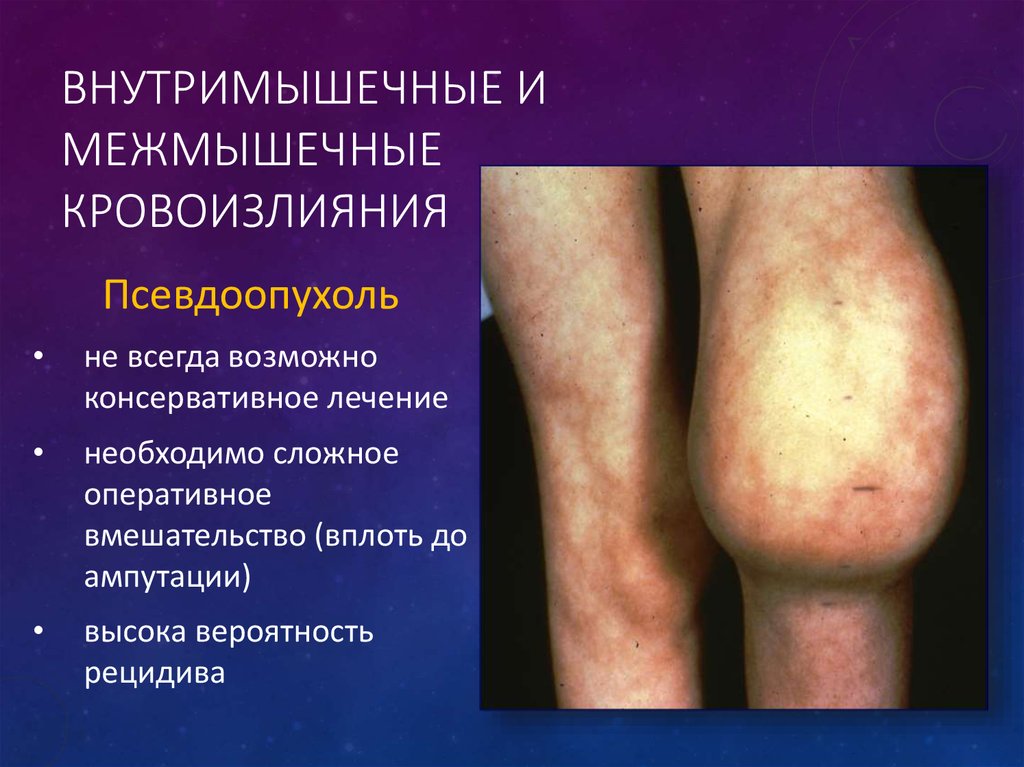 Внутримышечные и межмышечные кровоизлияния