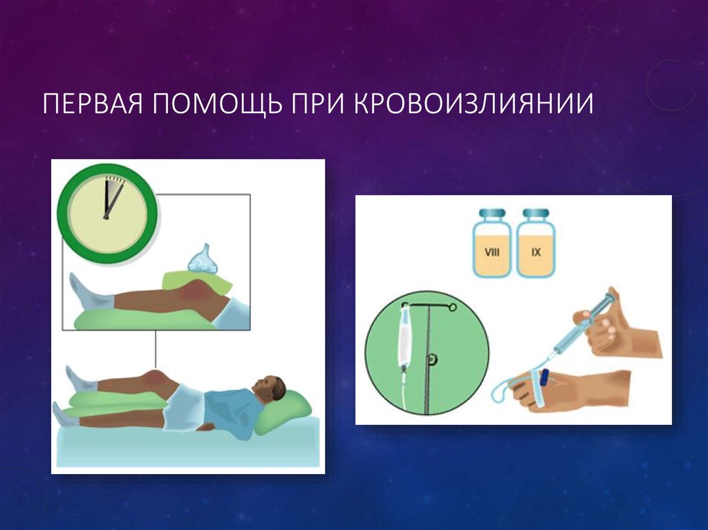 Первая помощь при кровоизлиянии