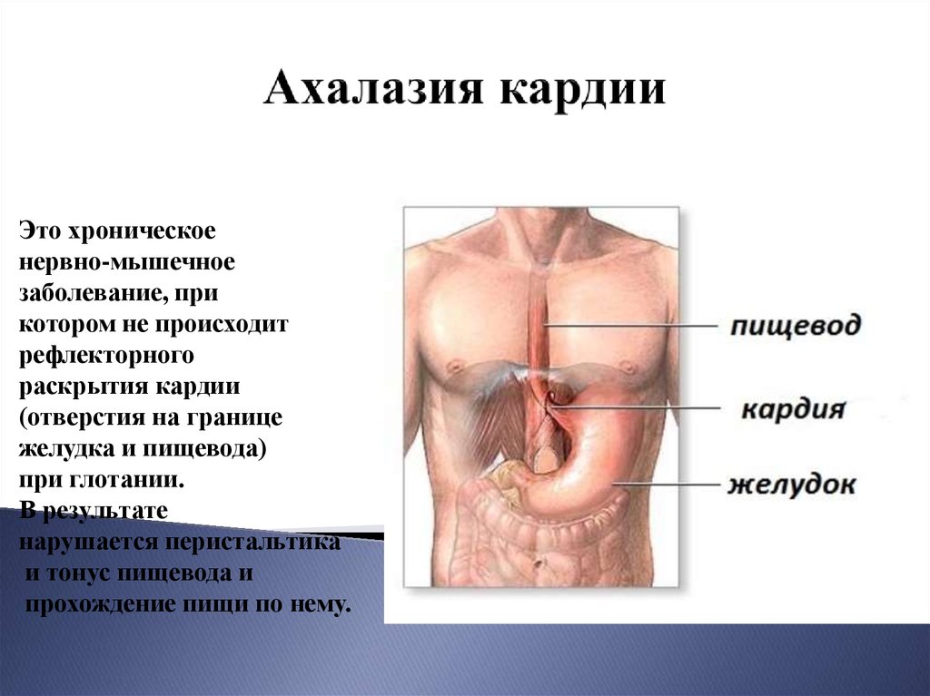 Эндоскопические признаки кардии. Ахалазия кардиальной части пищевода.