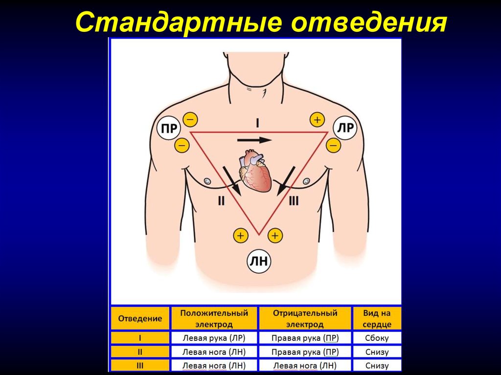 Картинка стандартные отведения