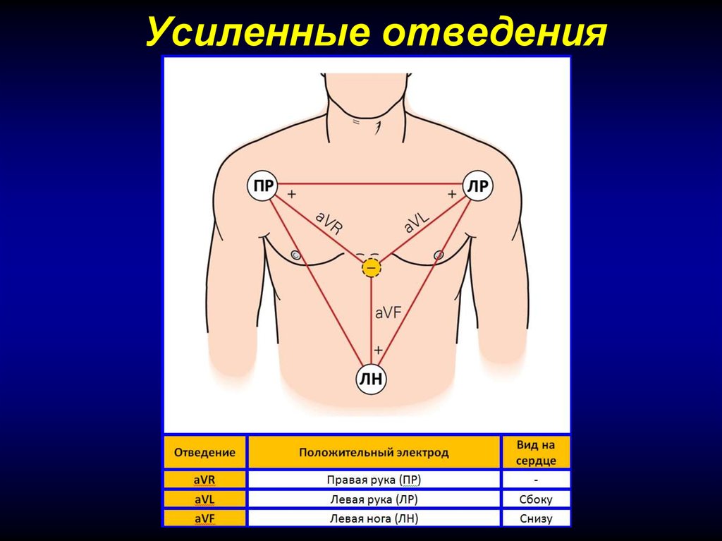 Наложение электродов экг картинки