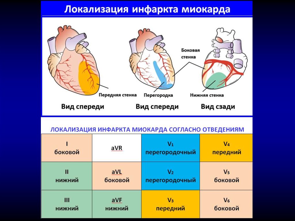 Изменения боковых отделов. Инфаинфаркт миокарда локализация. Локализации инфаркта миокарда на ЭКГ. Локализация нфарктовмиокарда. Отведения на ЭКГ И локализация.