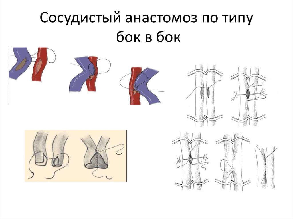 Анастомоз конец в конец схема