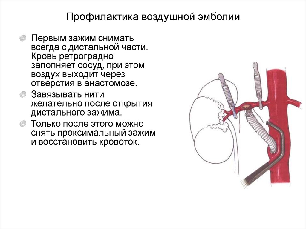 Ретроградная эмболия