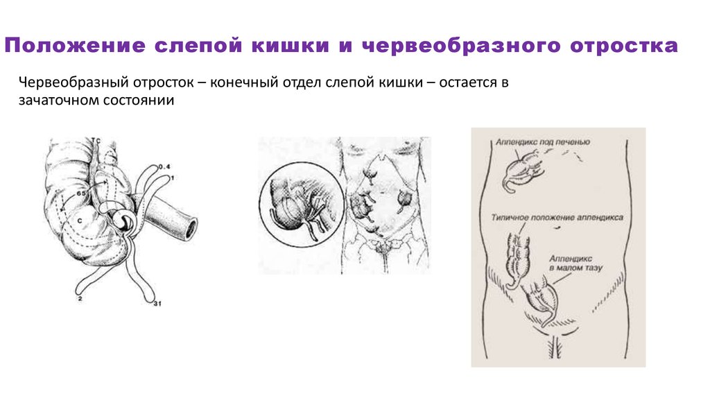 Аппендикс расположение схема