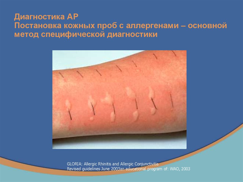 Диагностика АР Постановка кожных проб с аллергенами – основной метод специфической диагностики