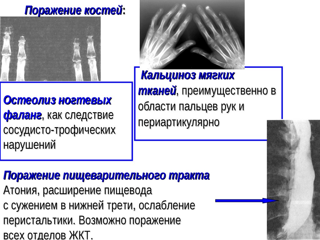 Остеолиз ногтевых фаланг, как следствие сосудисто-трофических нарушений
