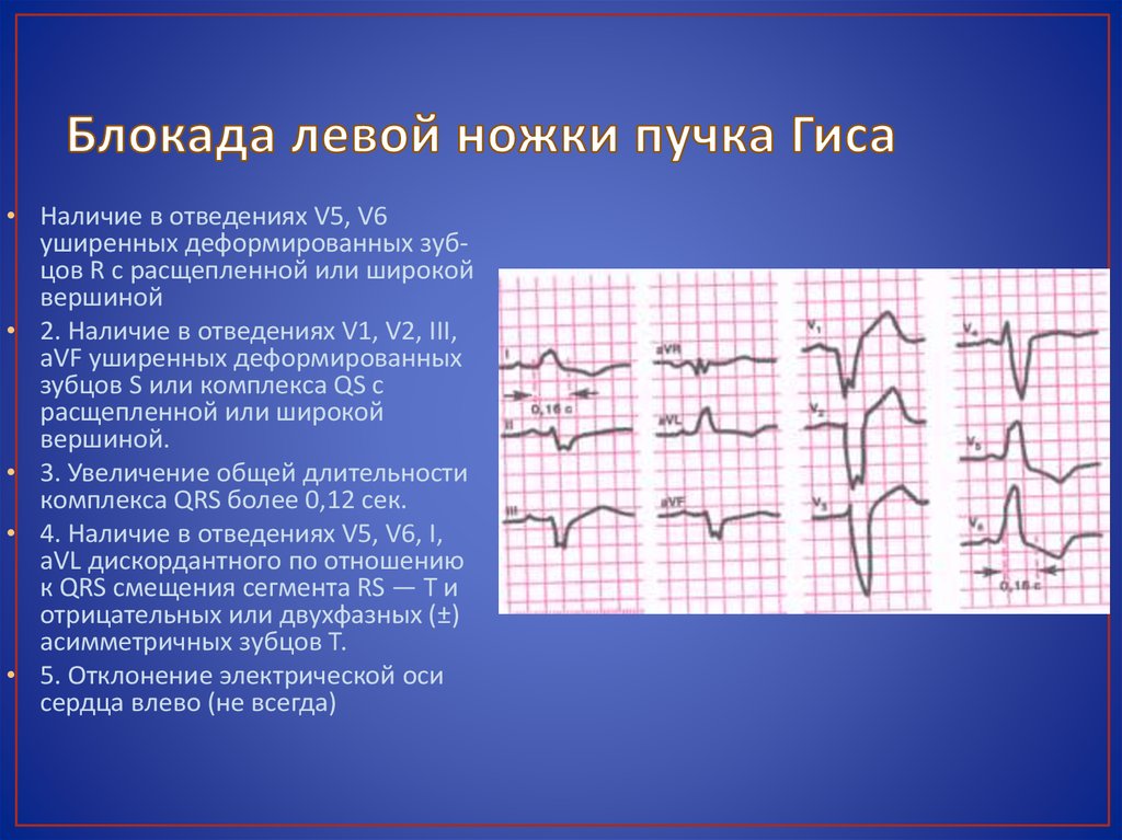 Неполная блокада ножки гиса на экг. Блокада левой ножки пучка Гиса. Блокада левой ножки пучка ги а. ЭКГ блокада левой ножки пучка. Блокада ножек пучка Гиса на ЭКГ.