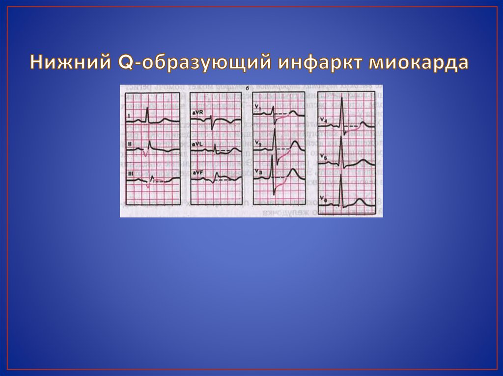 Оим это. Q образующий инфаркт миокарда. Q Нижний инфаркт миокарда. Q образующий инфаркт и не q. ЭКГ не q образующего инфаркта.