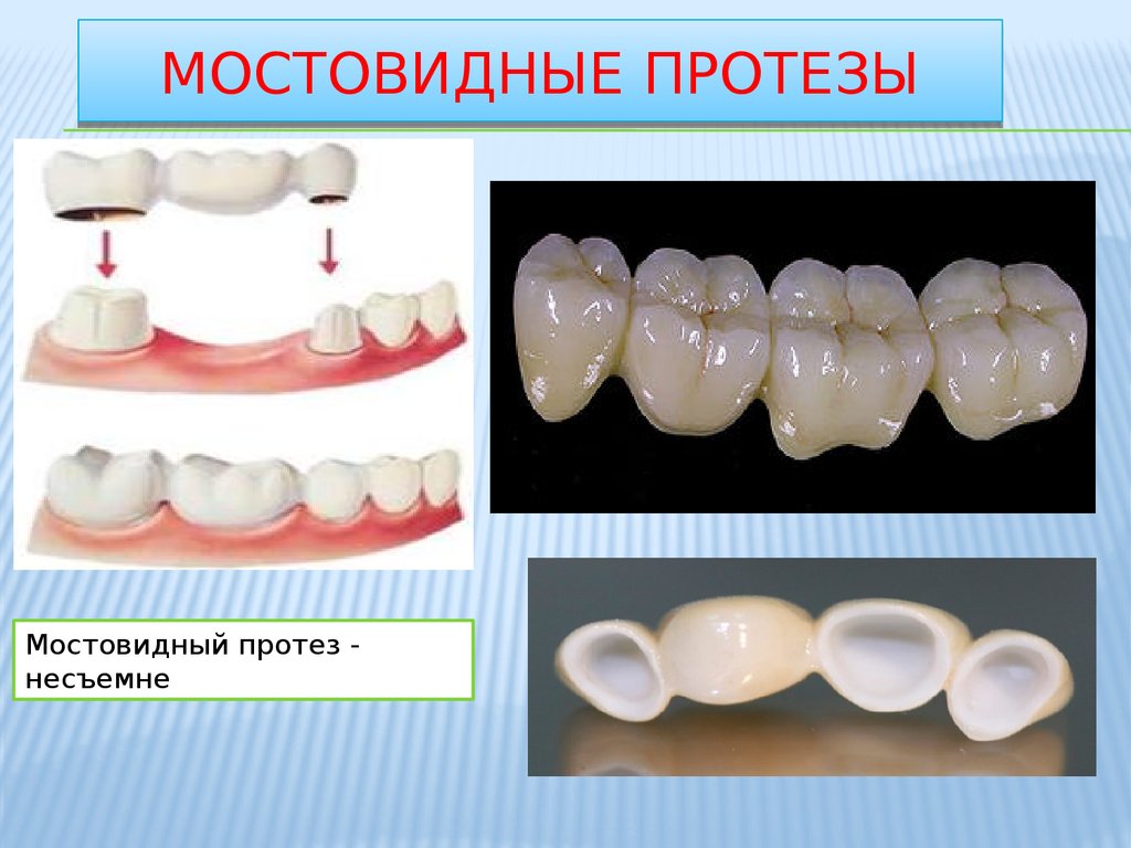 Презентация керамика в стоматологии