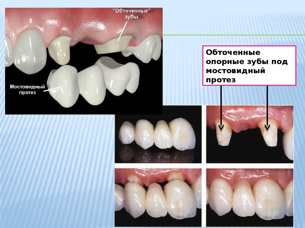 Презентация керамика в стоматологии