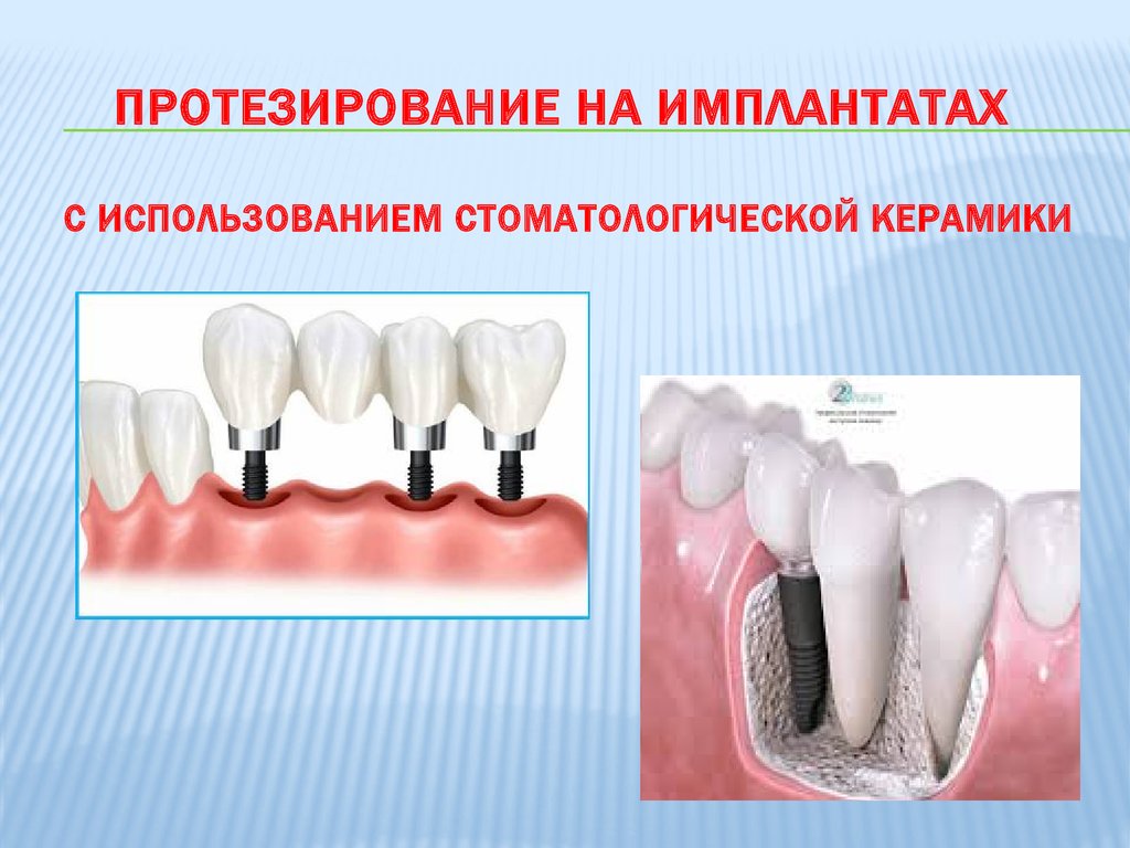 Стоматологическая керамика презентация