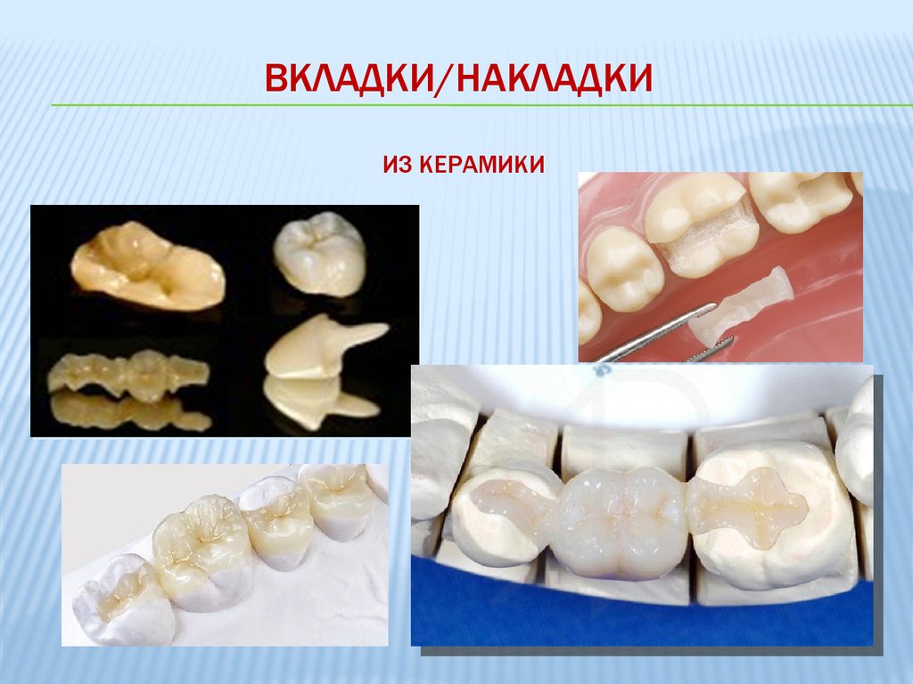 Презентация керамика в стоматологии