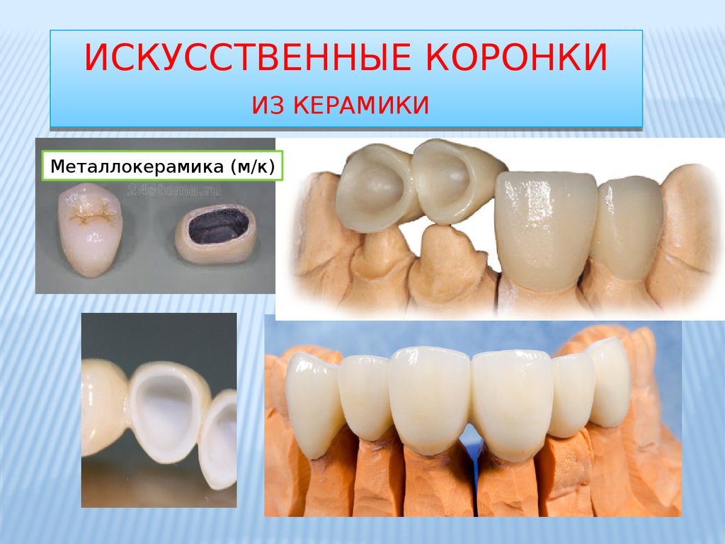 Презентация безметалловая керамика