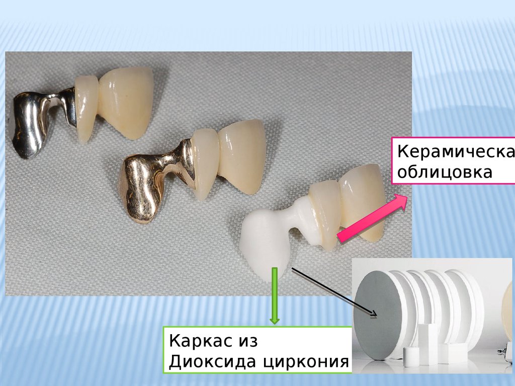 Циркониевая коронка преимущества