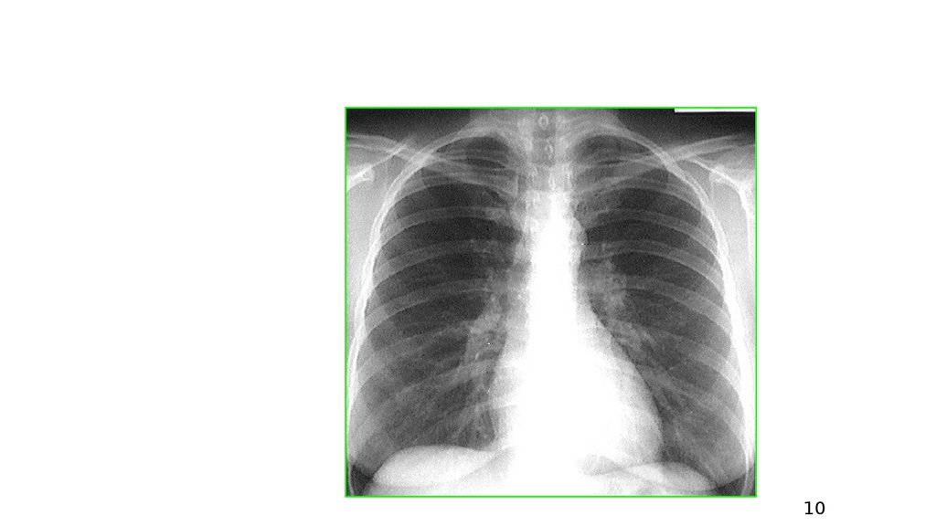 Рентгенограмма органов грудной клетки в прямой проекции