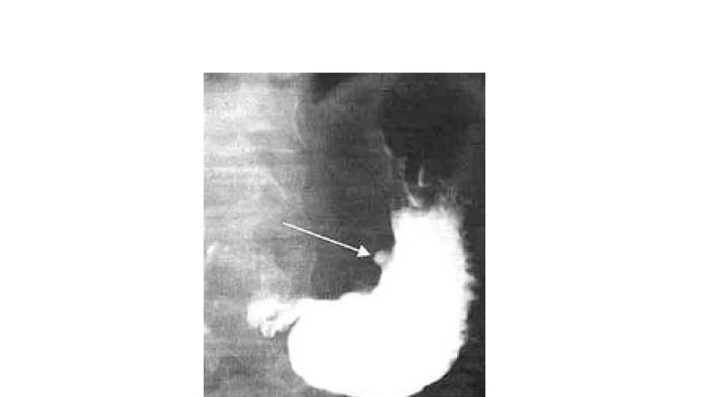 Язвенная болезнь желудка