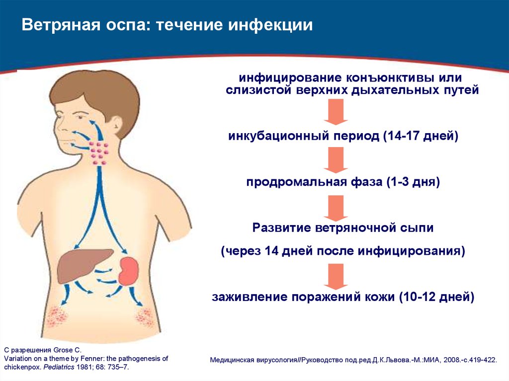 Ветряная оспа картинки лечение