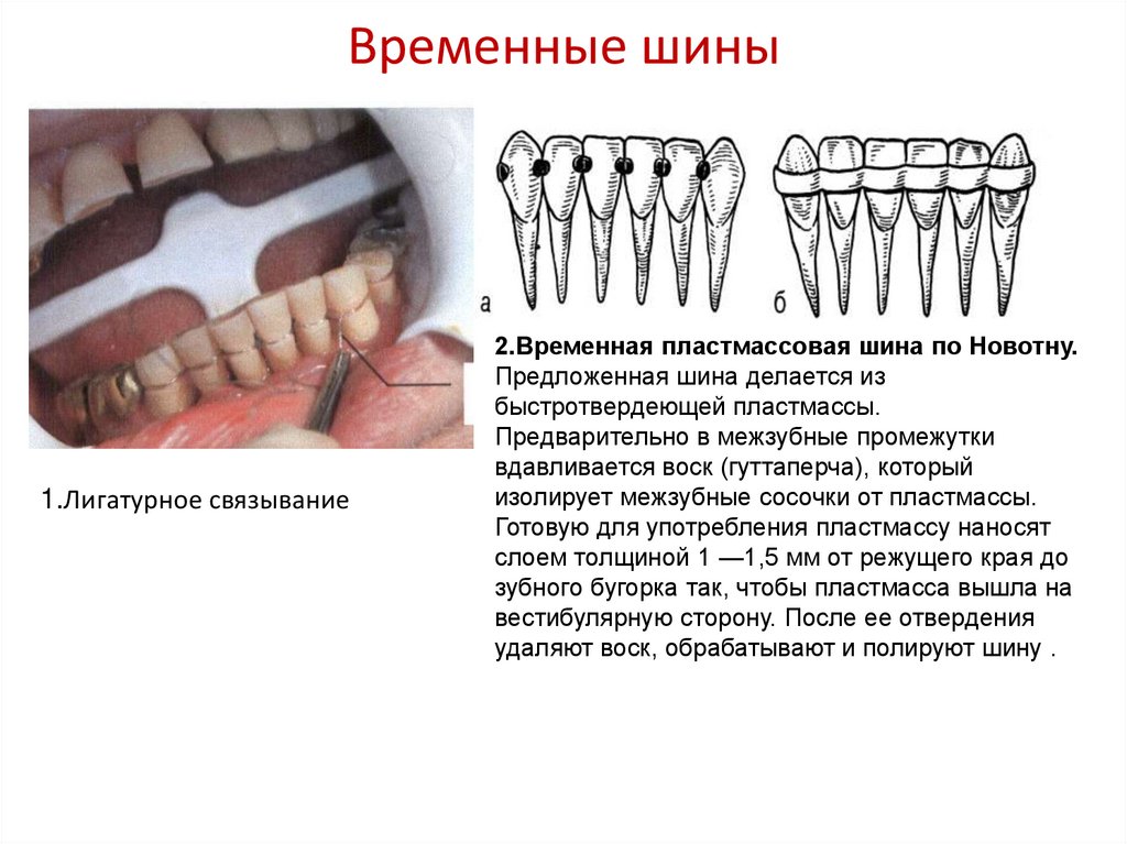 Ортопедические методы лечения генерализованного пародонтита презентация