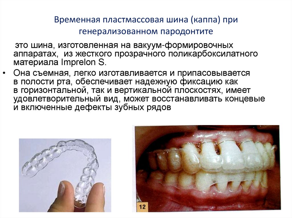 Ортопедические методы лечения генерализованного пародонтита презентация