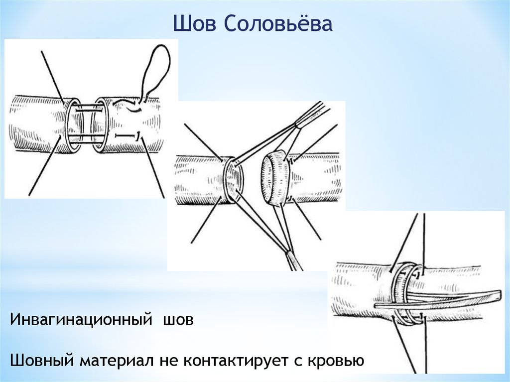 Сосудистый шов история