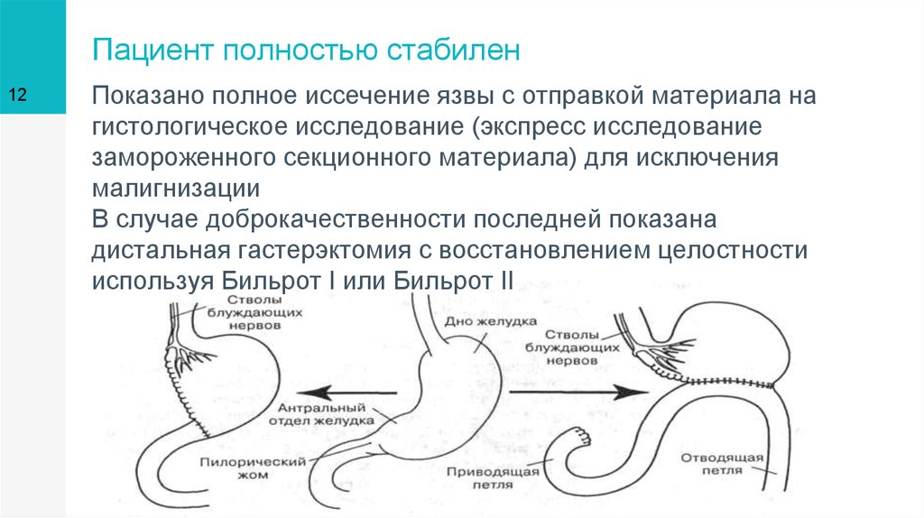 Бильрот 1 и 2 схема кратко