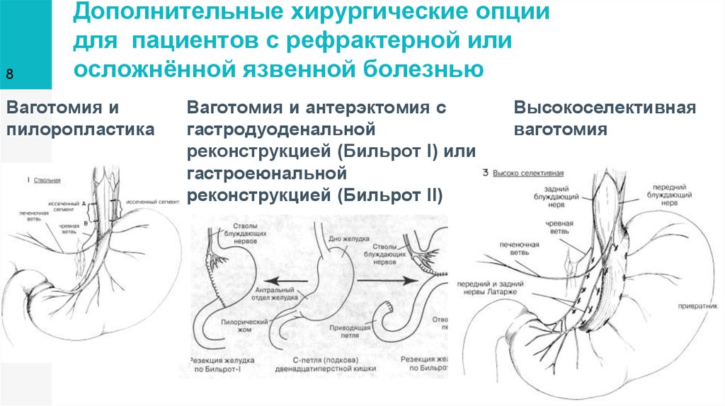 Схема мобилизации двенадцатиперстной кишки по кохеру