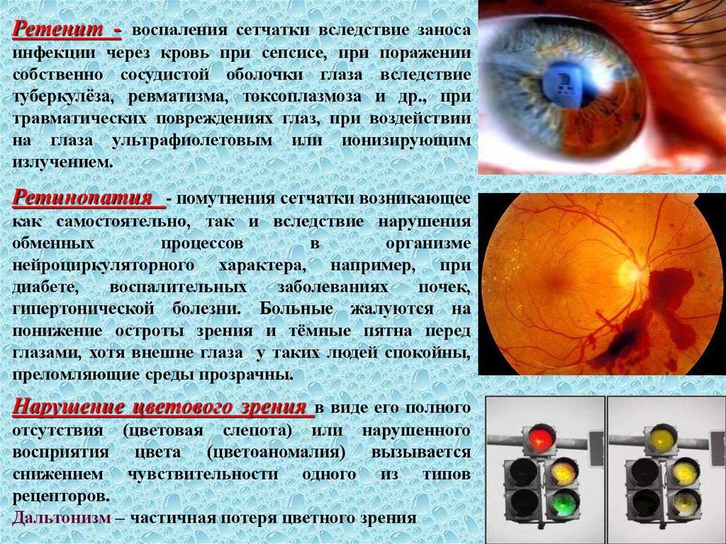 Воспаление сетчатки. Ожоги сетчатки УФ лучами. Поражение глаз ультрафиолетом. Органы зрения при диабете. Помощь при поражении глаз.