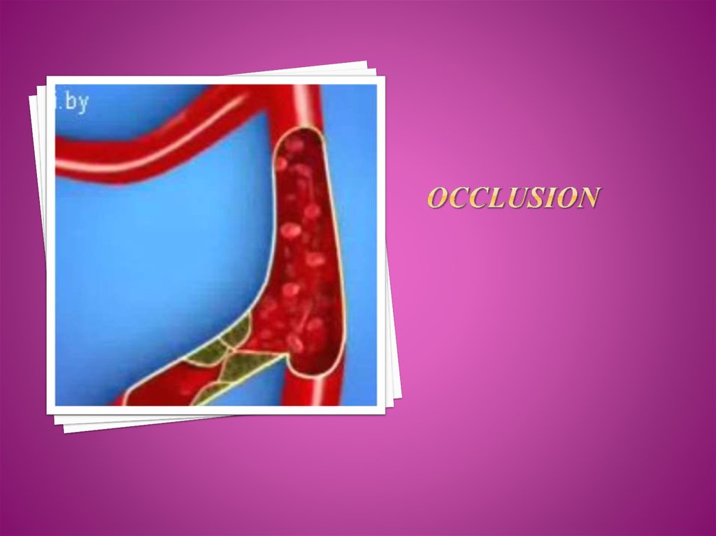 Occlusion