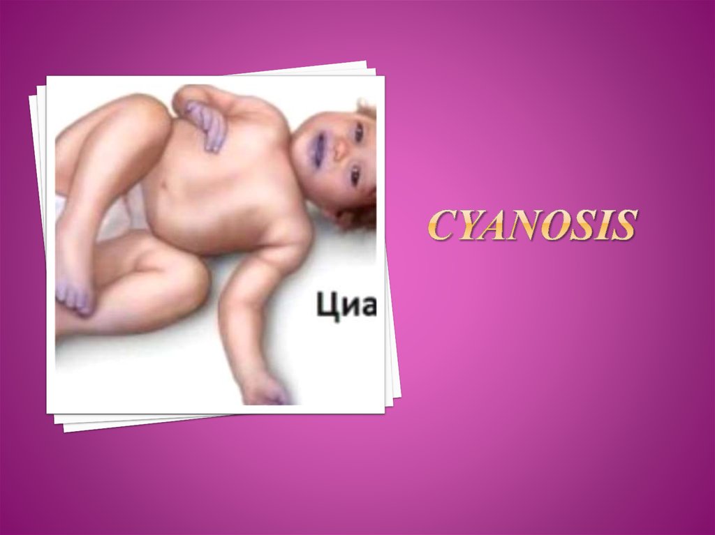 cyanosis