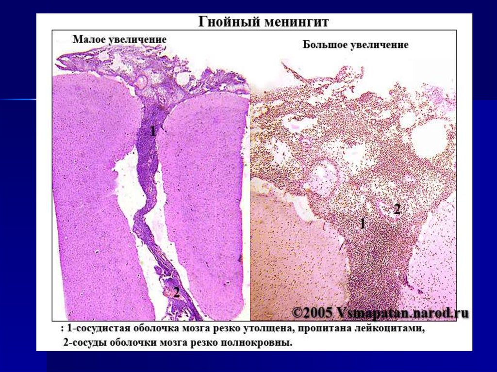 Гнойный менингит. Гнойный менингит гистопрепарат. Гнойный менингит препарат патанатомия. Менингит патологическая анатомия. Мягкая мозговая оболочка микропрепарат.
