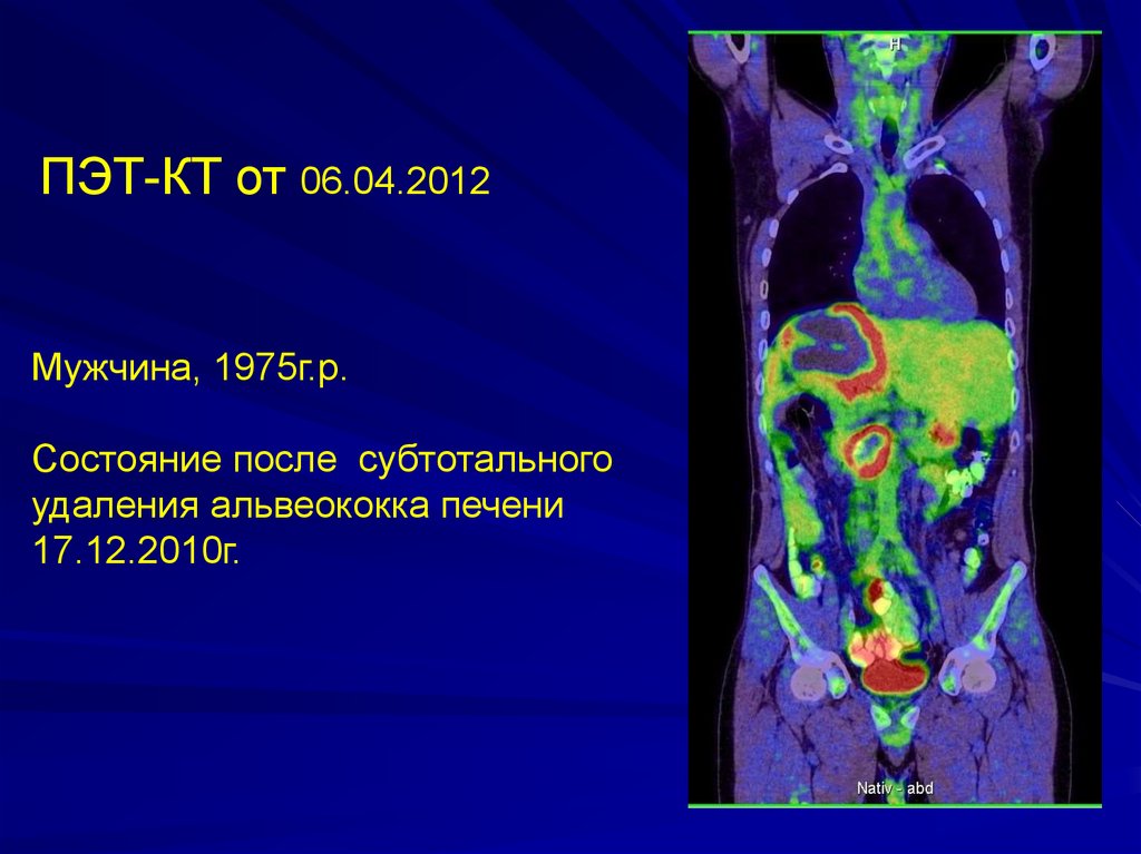 Расшифровка пэт кт онкологии