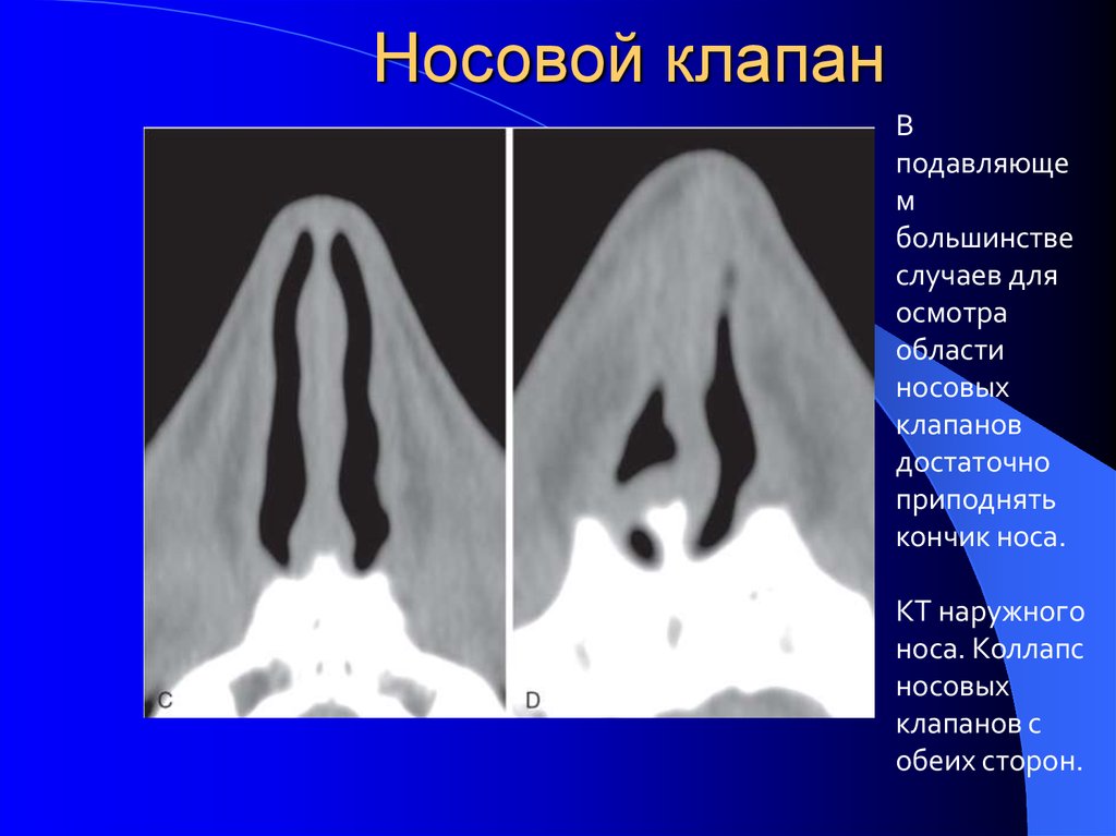 Что такое носовой клапан