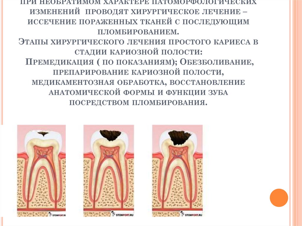 Осложнения лечения кариеса