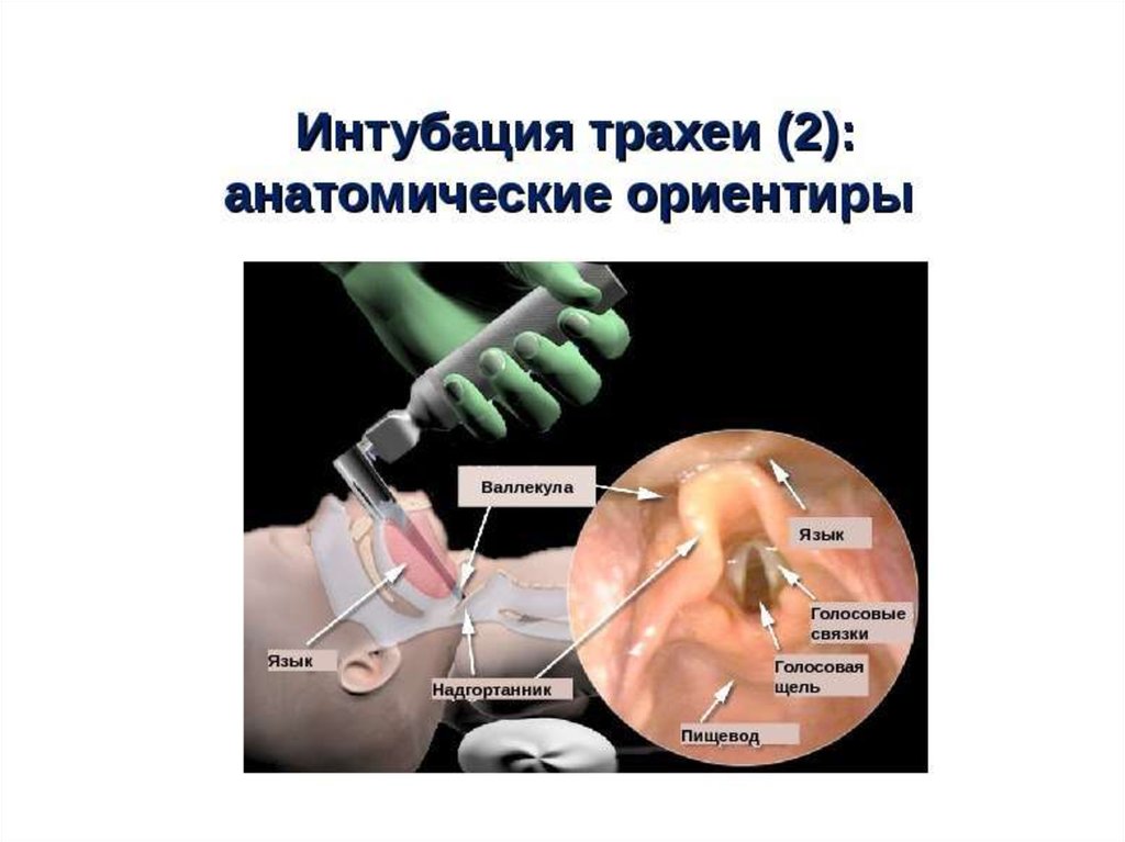 Интубация трахеи презентация