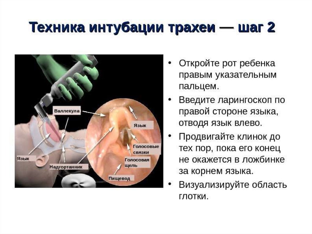 Фар трудная интубация