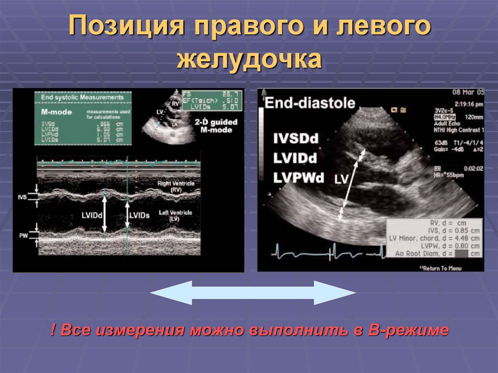 Правая позиция. Положение пациента при проведении эхокардиографии. Dp/DT эхокардиография. Функции медсестры при проведении эхокардиографии. Эхокардиография таблица при ложной хорде.