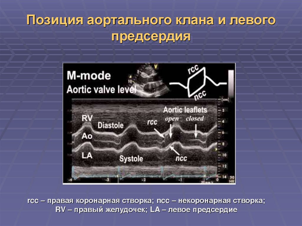 М режим. М-модальное исследование. М-режим эхокардиографии обозначения. Бикуспидальный аортальный клапан у детей. М модальное исследование митрального клапана.