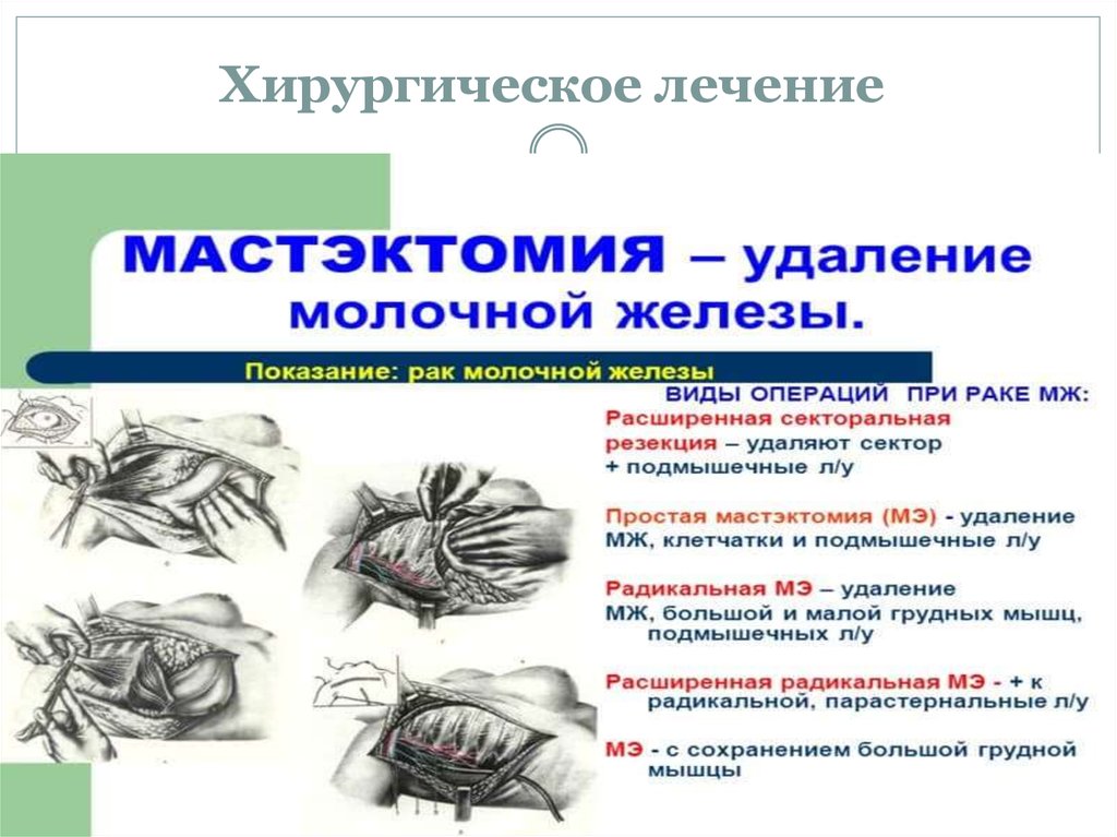 После резекции молочной железы. Секвестральная резекция молочной железы. Секторальная резекция грудной железы. Радикальная секторальная резекция молочной железы. Операция радикальная резекция молочной железы.