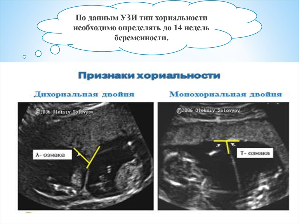 Ранние признаки многоплодной беременности. УЗИ информация. Типы УЗИ. Признаки хориальности на УЗИ. Гастрошизис протокол УЗИ.