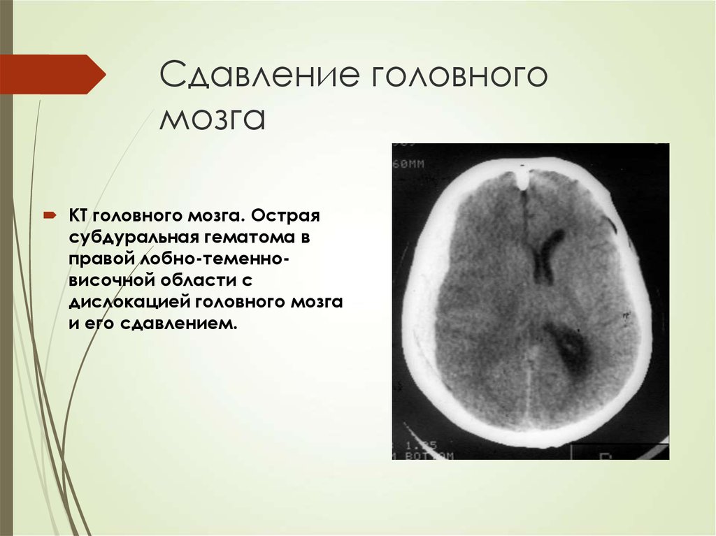 Сдавление мозга признаки. Сдавление головного мозга кт. Субдуральная и эпидуральная гематома. Эпидуральная гематома сдавление головного мозга кт.