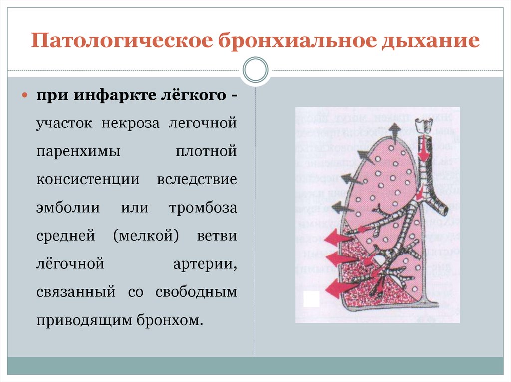 Бронхиальное дыхание. Стенотическое бронхиальное дыхание. Аускультация бронхиального дыхания. Аускультация легких бронхиальное дыхание. Везико-бронхиальное дыхание.